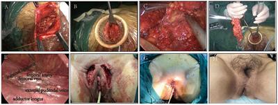 Analysis of Short-Term Efficacy of Gasless Single-Port Laparoscopic Inguinal Lymphadenectomy Through Vulva Incision for Vulvar Cancer